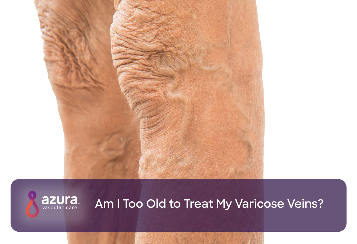 Occupations Most at Risk for Varicose Veins - How to Help