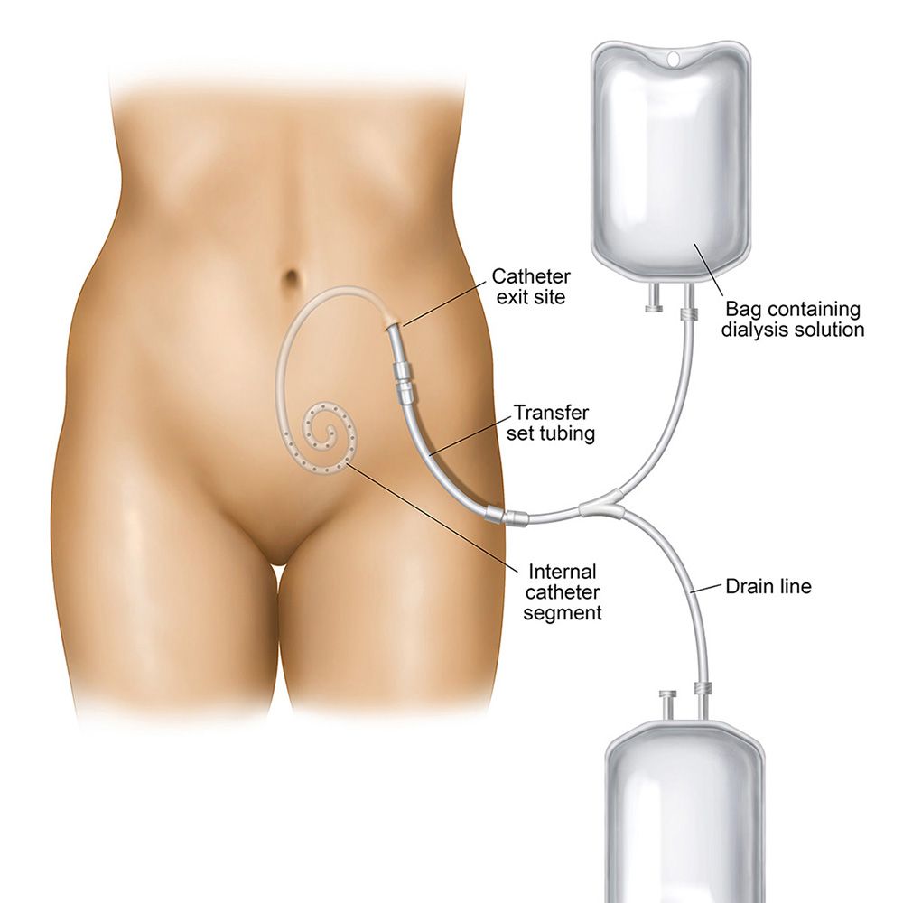 peritoneal dialysis catheter exit site