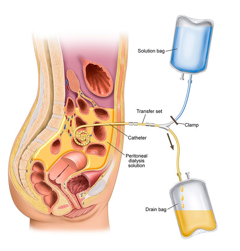 peritoneal dialysis catheter