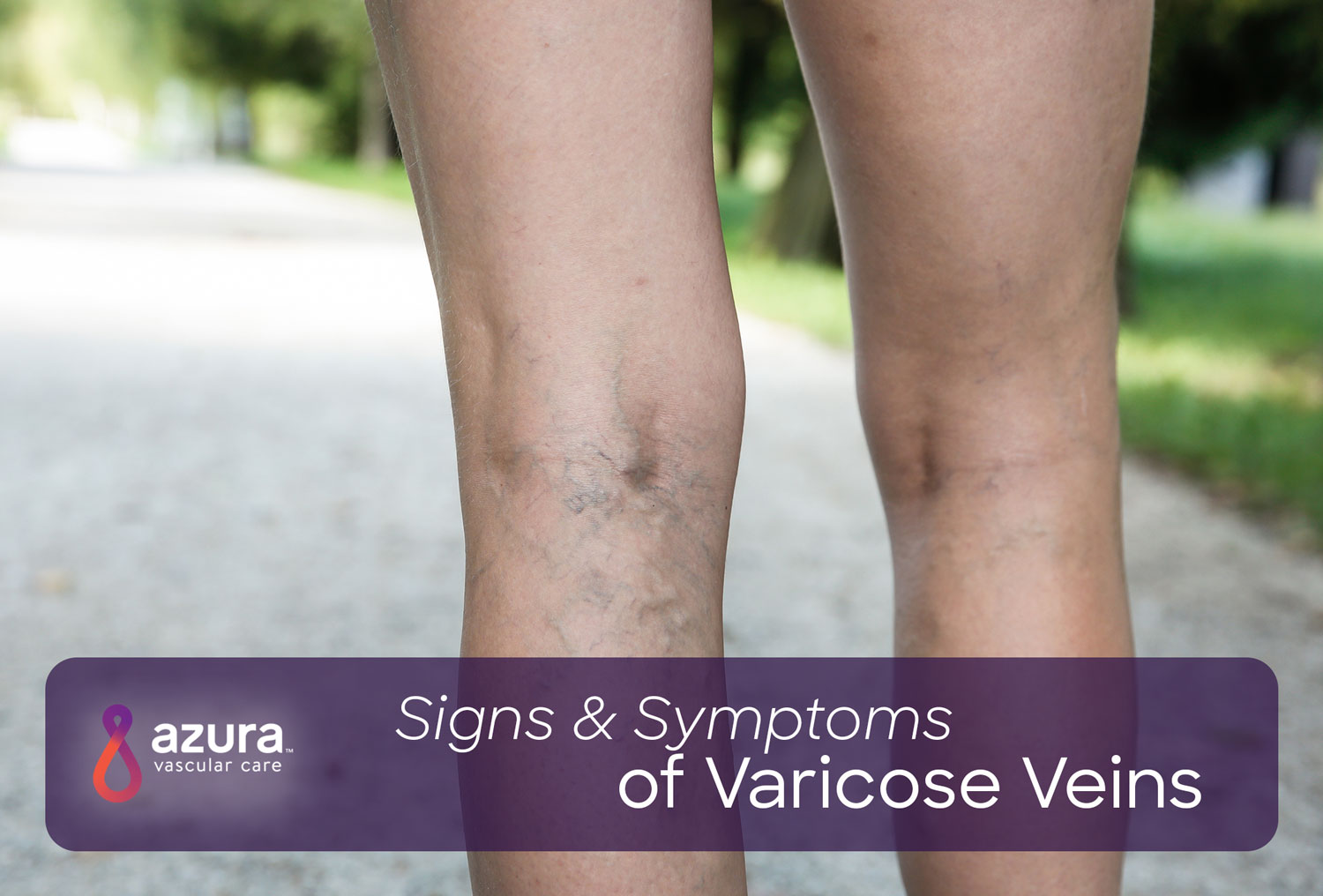 Signs & Symptoms of Varicose Veins
