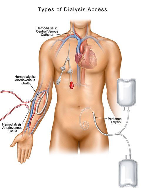 hemodialysis tunneled catheter