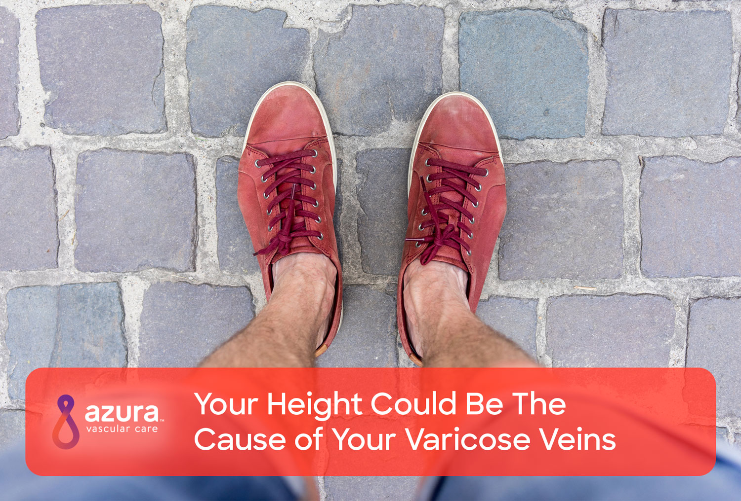 Signs & Symptoms of Varicose Veins