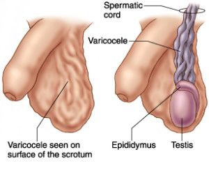 schema del varicocele