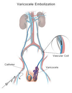 Varicocele. Varicocele & Male Infertility Cure Book. Varicocele