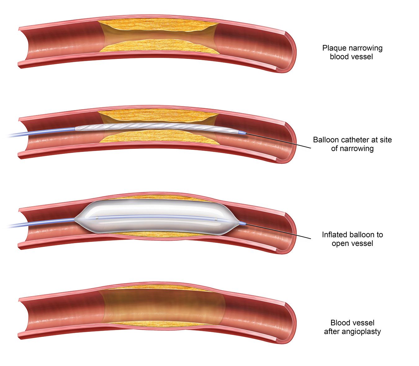 Angioplasty and Stent Placement Procedures | Azura Vascular Care