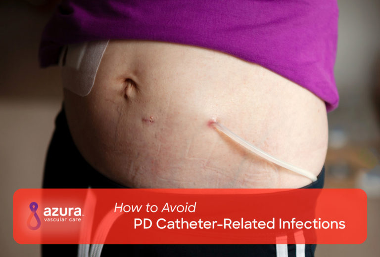 How to Avoid PD CatheterRelated Infections Azura Vascular Care