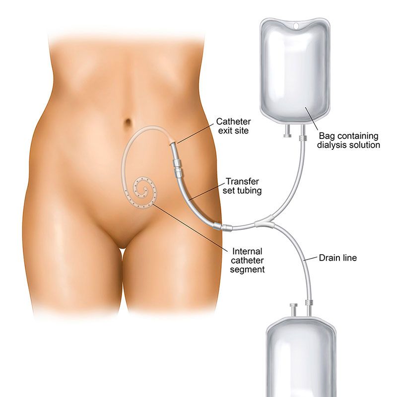 dialysis catheter types