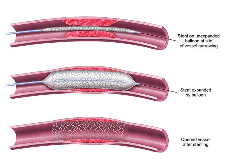 Angioplasty and Stent Placement Procedures | Azura Vascular Care