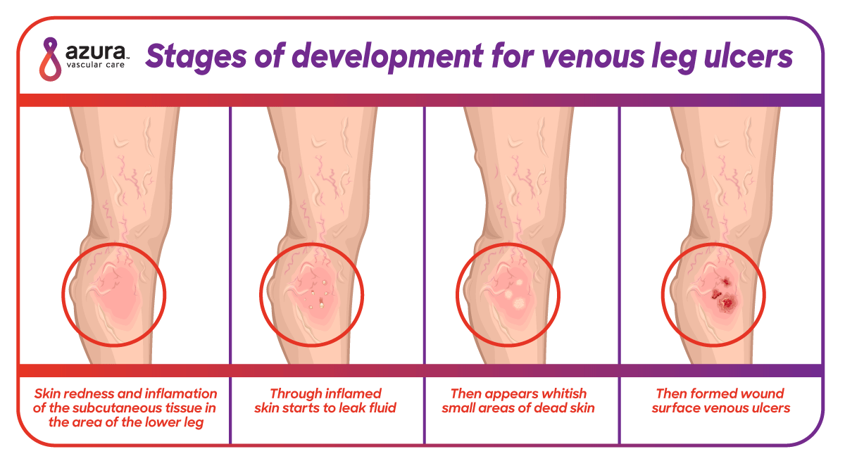 Icd Code For Bilateral Venous Stasis Ulcers