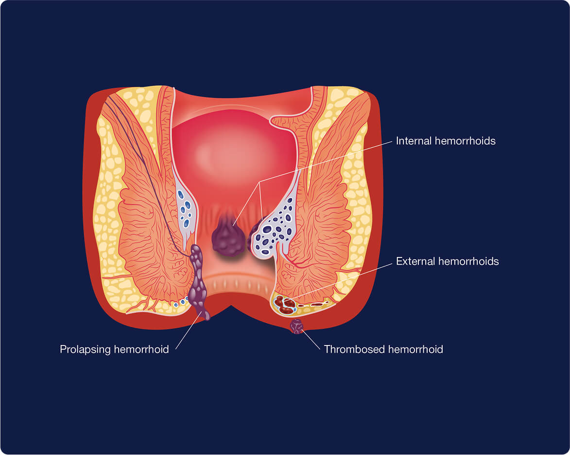 An illustration of the location and types of hemorrhoids